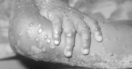 Lutte contre la variole de singe : l’Union européenne apporte une aide humanitaire à la RDC