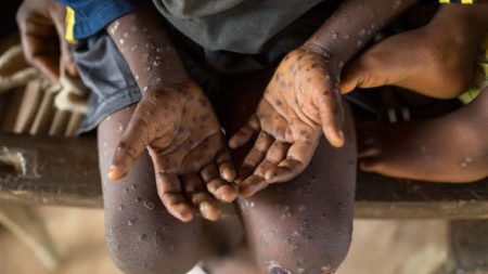 Nord-Kivu : déjà 8 cas de variole de singe enregistrés