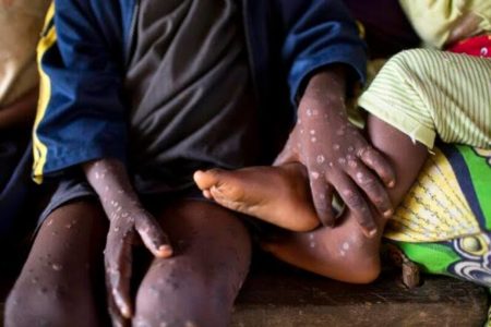 Santé : Kinshasa met en place un plan de riposte pour contenir la propagation de Mpox